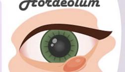 ものもらい(麦粒腫)